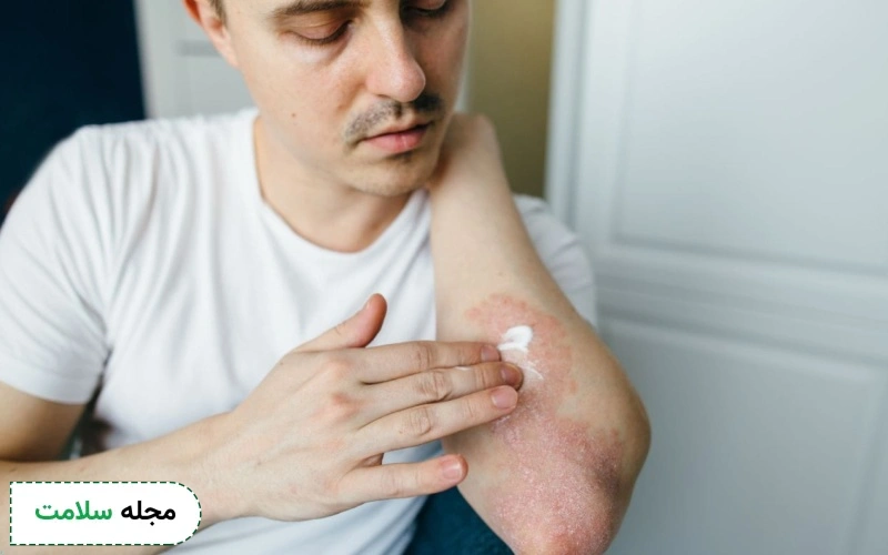 کرم تریامسینولون برای اگزما