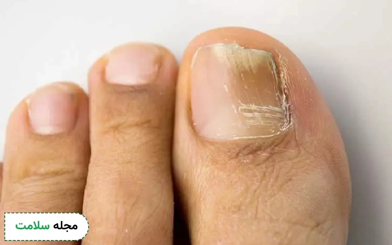 قرص یا کپسول ایتراکونازول 100 برای چیست؟