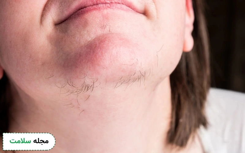 عوارض قرص اسپیرونولاکتون چیست؟