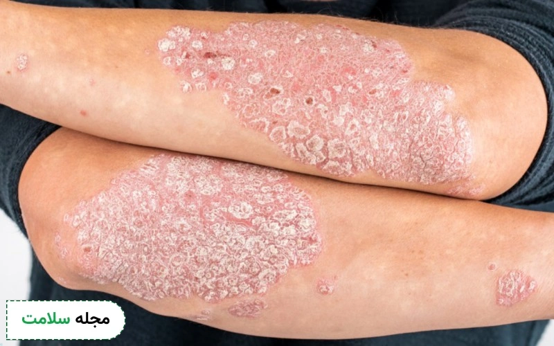 داروی متوتروکسات برای چیست؟