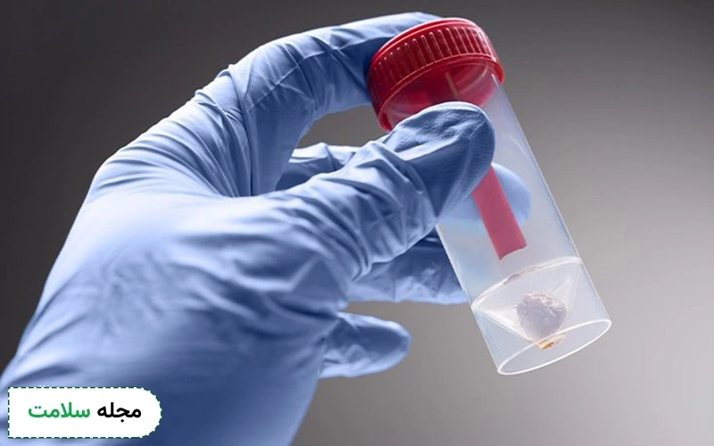 مراحل آزمایش و تجزیه و تحلیل نمونه مدفوع چگونه است؟
