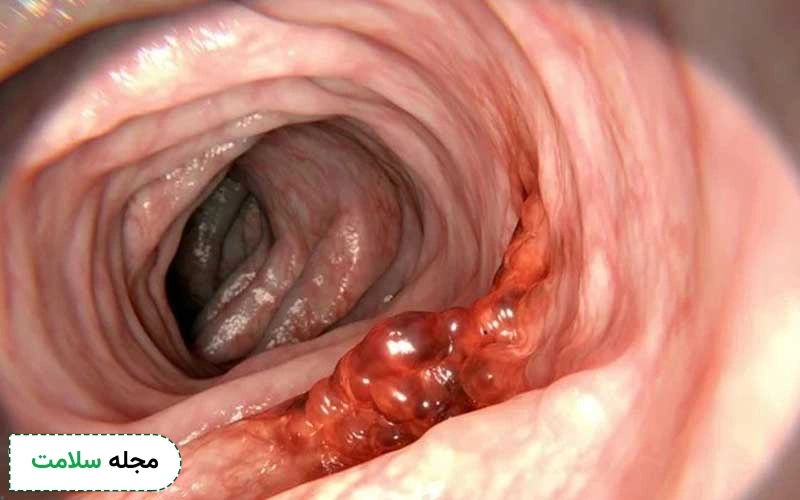 تست های خانگی سرطان روده محدودیت‌ها و معایبی هم دارند.
