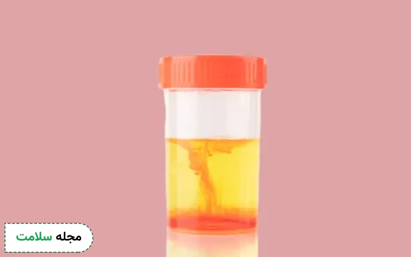 بررسی علل و پیامدهای Blood مثبت در آزمایش ادرار