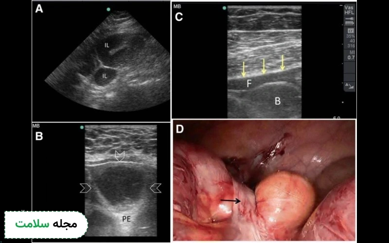 سونوگرافی برای تشخیص سرطان روده حین عمل نیز می تواند انجام دهد.