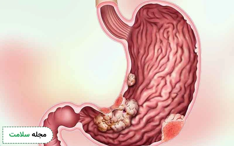 بررسی صفر تا صد تشخیص سرطان معده با اندوسکوپی