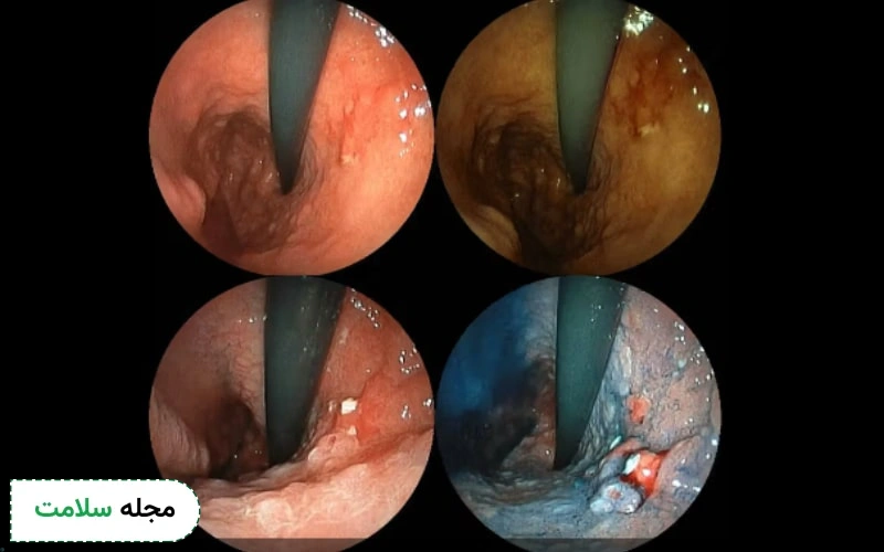  آندوسکوپی زخم عکس سرطان معده بدخیم