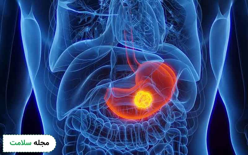 معایب تست سرطان معده در منزل