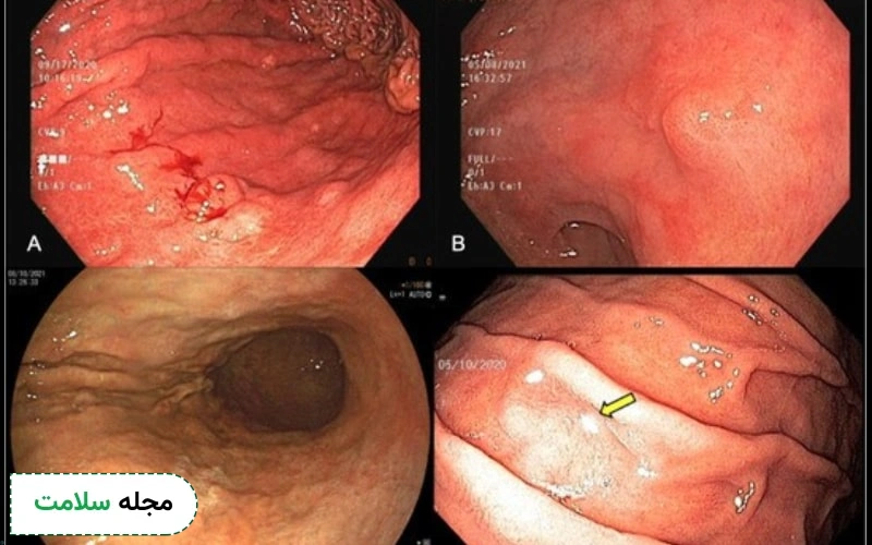 عکس آندوسکوپی سرطان معده