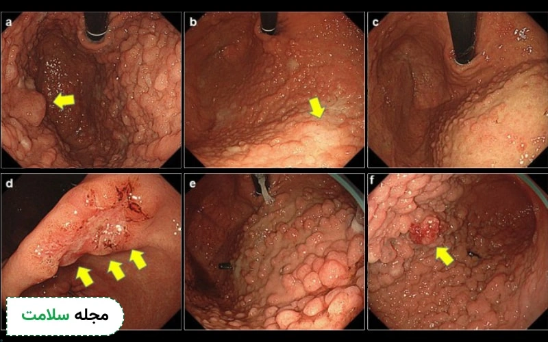عکس سرطان معده در آندوسکوپی