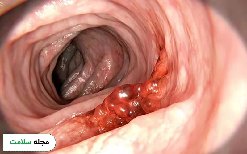 مزایا و محدودیت های آزمایش مدفوع در تشخیص سرطان روده چیست؟