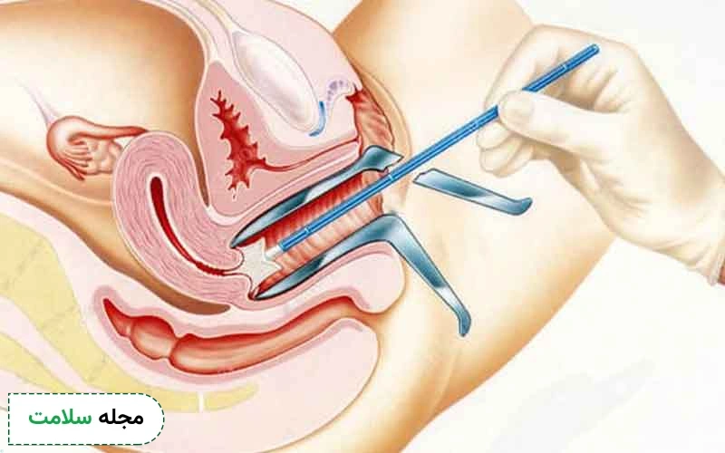 آمادگی های لازم پیش از انجام تست پاپ اسمیر در دوران پریود چیست؟