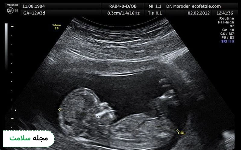 اکوژن در سونوگرافی بارداری یعنی چه؟