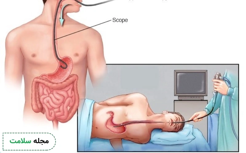 چطور جواب اندوسکوپی سرطان معده را بررسی کنیم؟
