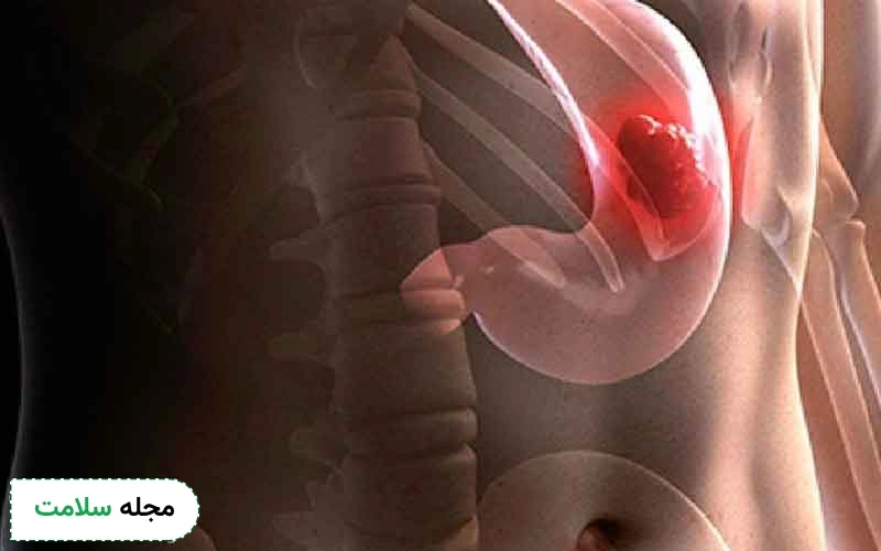 تشخیص سرطان معده با اندوسکوپی چگونه است؟