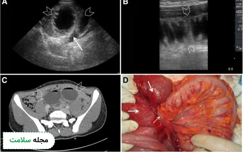 انواع سونوگرافی برای تشخیص سرطان روده انجام می شود.
