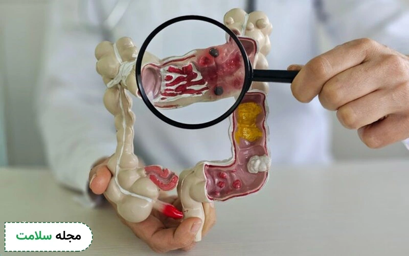 انواع آزمایش مدفوع در تشخیص سرطان روده چیست؟