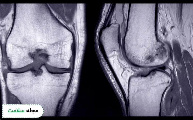 mri مغز استخوان میزان نسبی آب، چربی و پروتئین داخل استخوان را تغیین می‌کند.