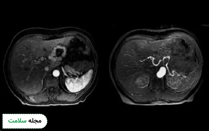مزایای MRI شکم و لگن چیست؟