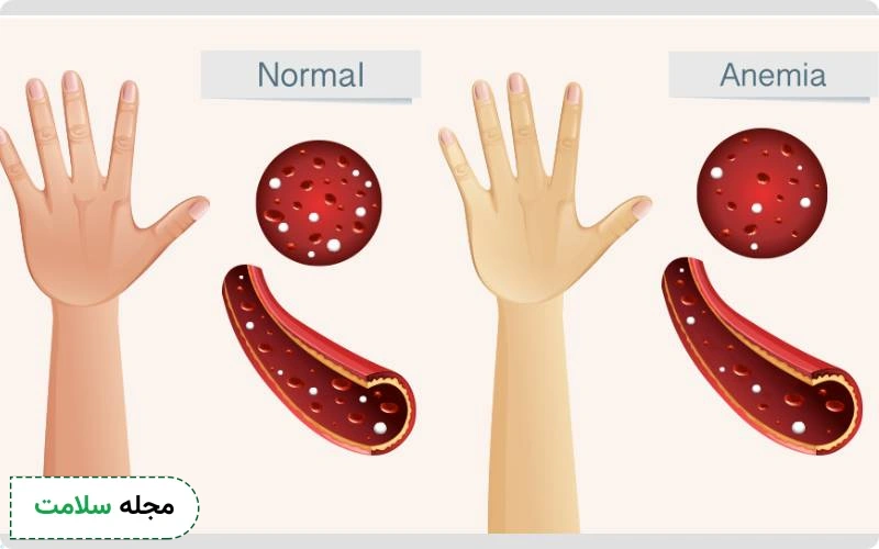 از دلایل اصلی MCHC پایین آنمی است