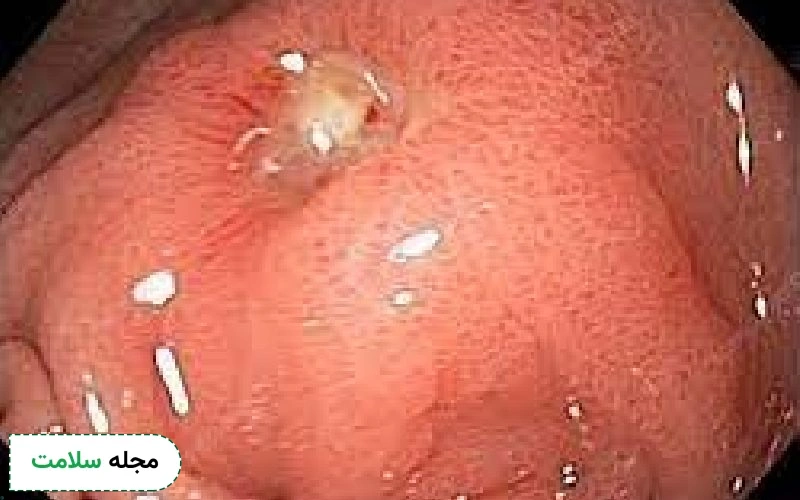 عکس زخم معده در اندوسکوپی