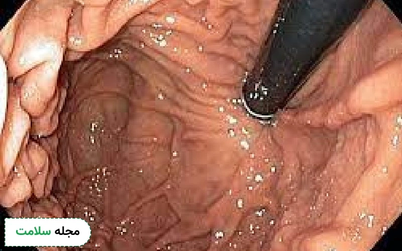 عکس آندوسکوپی معده سالم