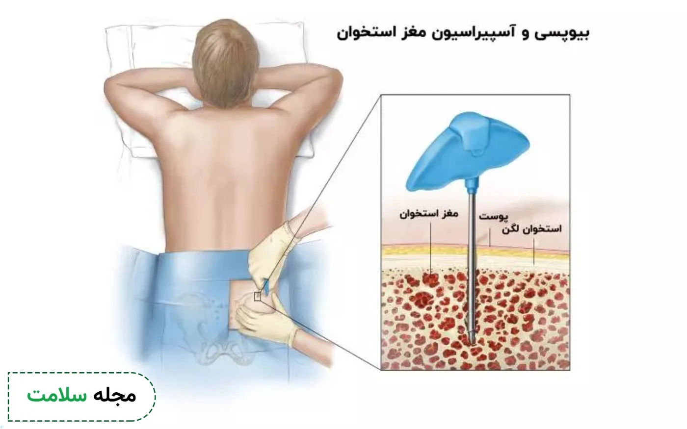 بیوپسی مغز استخوان در تست سرطان خون چیست؟