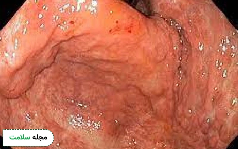 نحوه خواندن جواب اندوسکوپی چگونه است؟