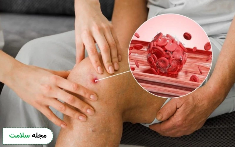عوارض پیوند مغز استخوان چیست؟