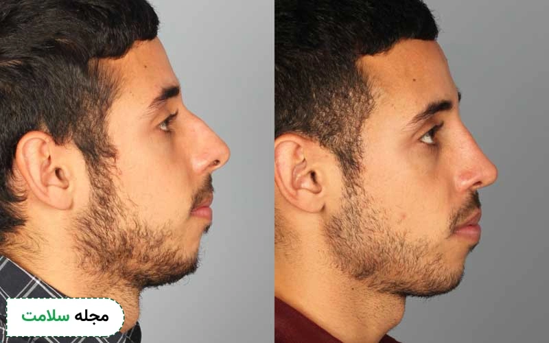 عکس یک نمونه عمل بینی مردانه فانتزی بدین شکل است. 