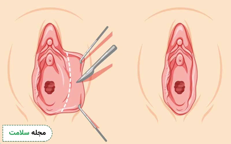 گوشت اضافه بعد از لابیاپلاستی به چه دلیلی ایجاد می شود؟