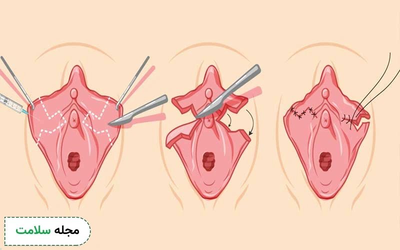 خطای جراحی از دلایل ایجاد گوشت اضافه بعد از لابیاپلاستی است.