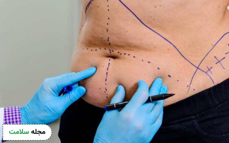 جراحی زیبایی شکم و هر آنچه باید درباره آن بدانید