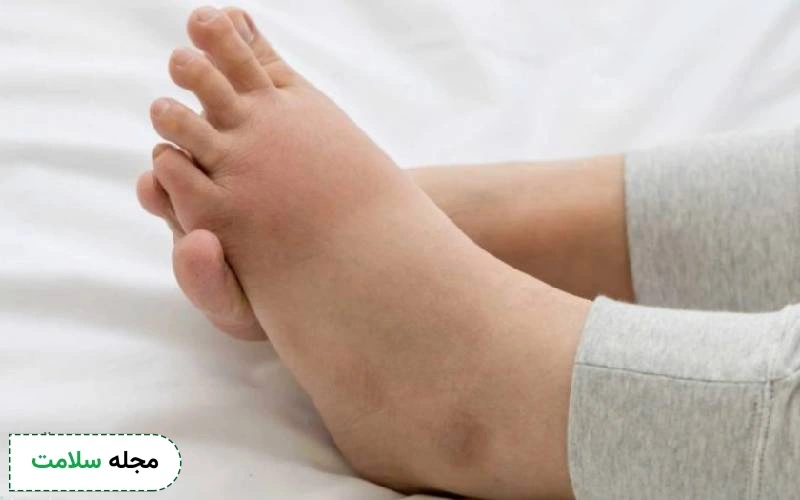 علائم ورم پا بعد از زایمان