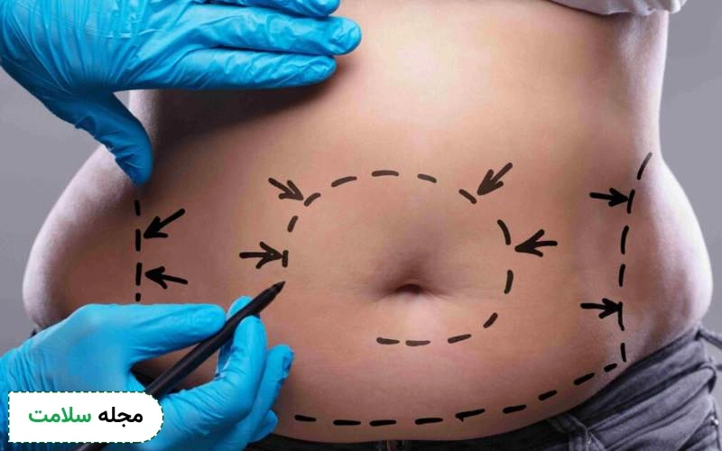 کاربردهای جراحی زیبایی شکم چیست؟