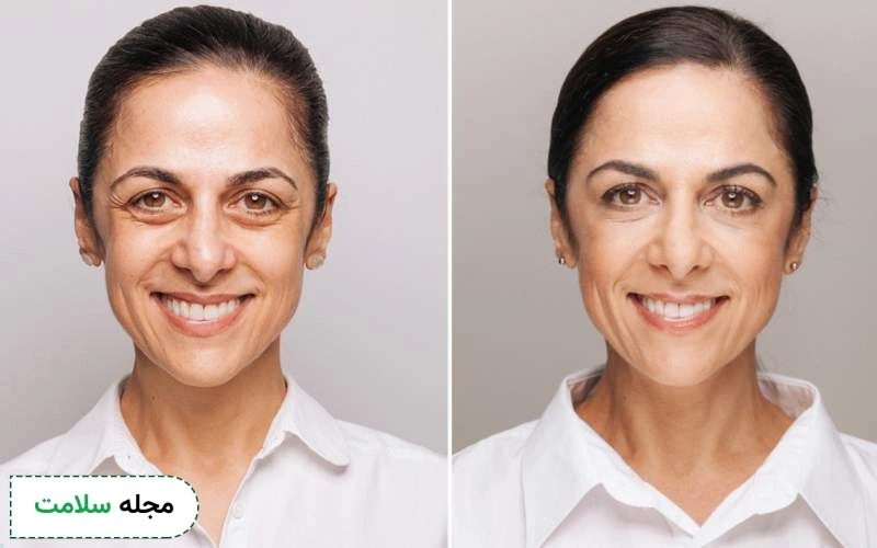 کاربردهای بوتاکس زیر چشم چیست؟