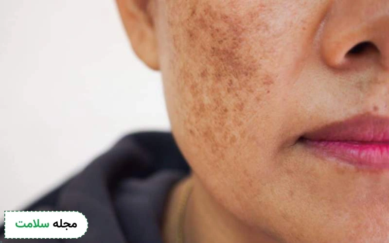 عوارض هایفوتراپی پوست چیست؟