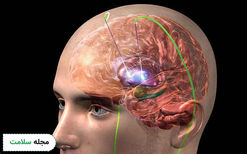 تحریک الکتریکی مغز چیست؟