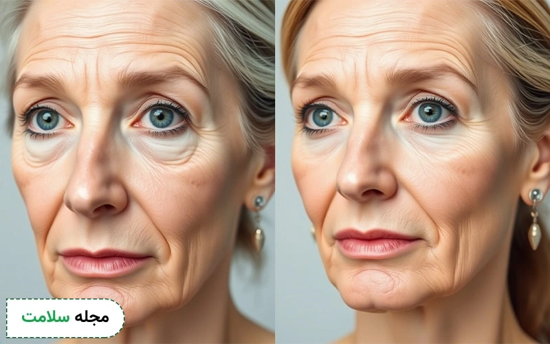 بهترین سن بوتاکس چه سنی است؟