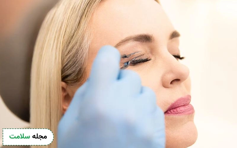 بهترین زمان برای تزریق بوتاکس بعد از بلفاروپلاستی چه زمانی است؟