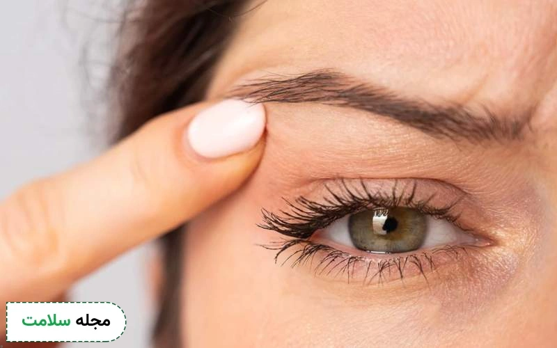 افتادگی پلک بعد از بوتاکس چیست؟