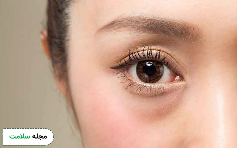 تفاوت کانتوپلاستی و بلفاروپلاستی چیست؟