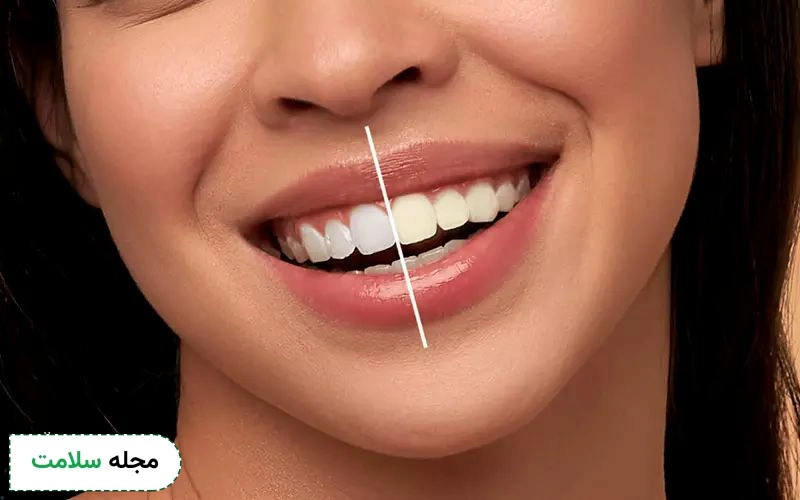 روش های سفید کردن دندان در خانه چیست؟