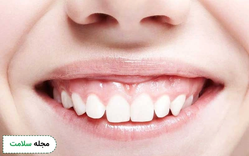 لبخند لثه ای چیست؟ آیا این وضعیت مشکل ساز است؟ راه درمان آن چیست؟