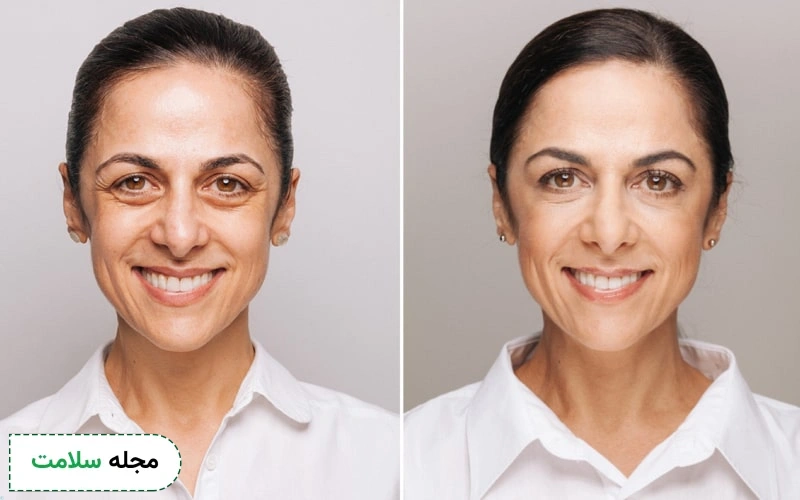 عکس قبل و بعد از تزریق چربی به زیر چشم چگونه است؟