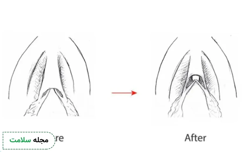 جراحی کوچک کردن کلاهک کلیتوریس چگونه انجام میشود؟