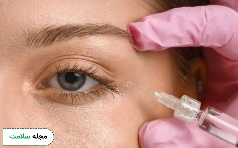 از ژل الانسه در کدام نواحی صورت استفاده میشود؟ مزایا و عوارض این فیلر چیست؟