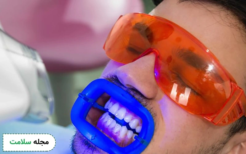 افیس بلیچینگ در چند جلسه انجام میشود؟