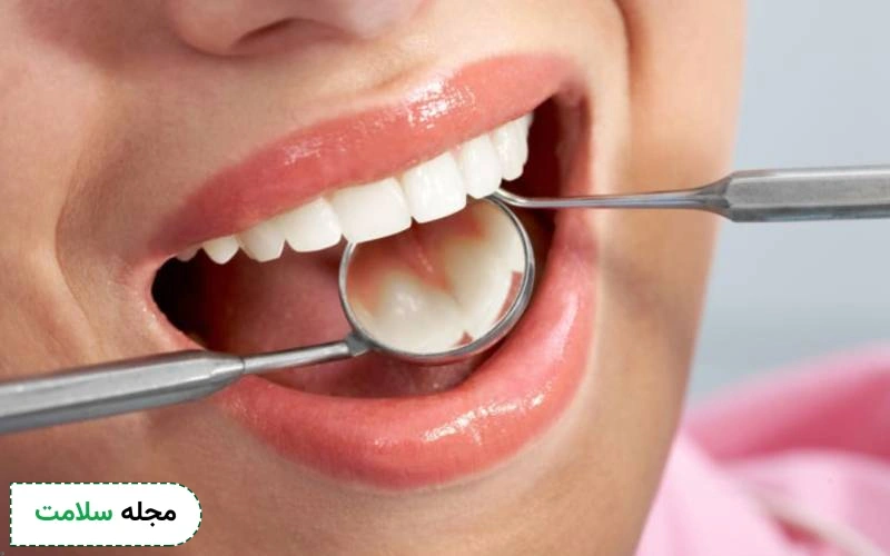 کامپوزیت کاریزما چه مزیت هایی دارد؟ استحکام و طیف رنگ آن چگونه است؟