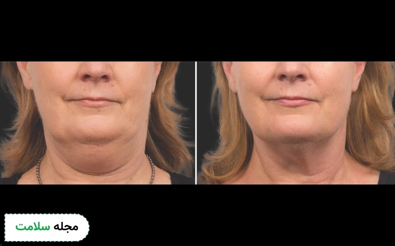 کاربرد هایفوتراپی غبغب رفع چربی این ناحیه است.