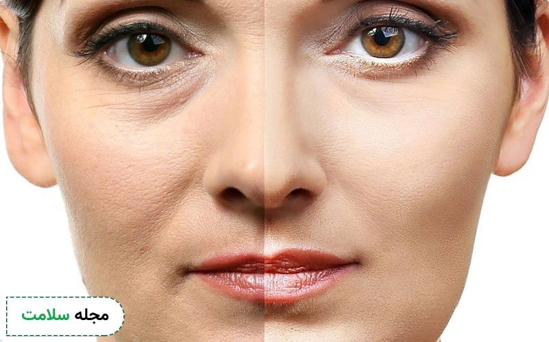 عوارض و خطرات پلاسما تراپی خط خنده بسیار کم است.